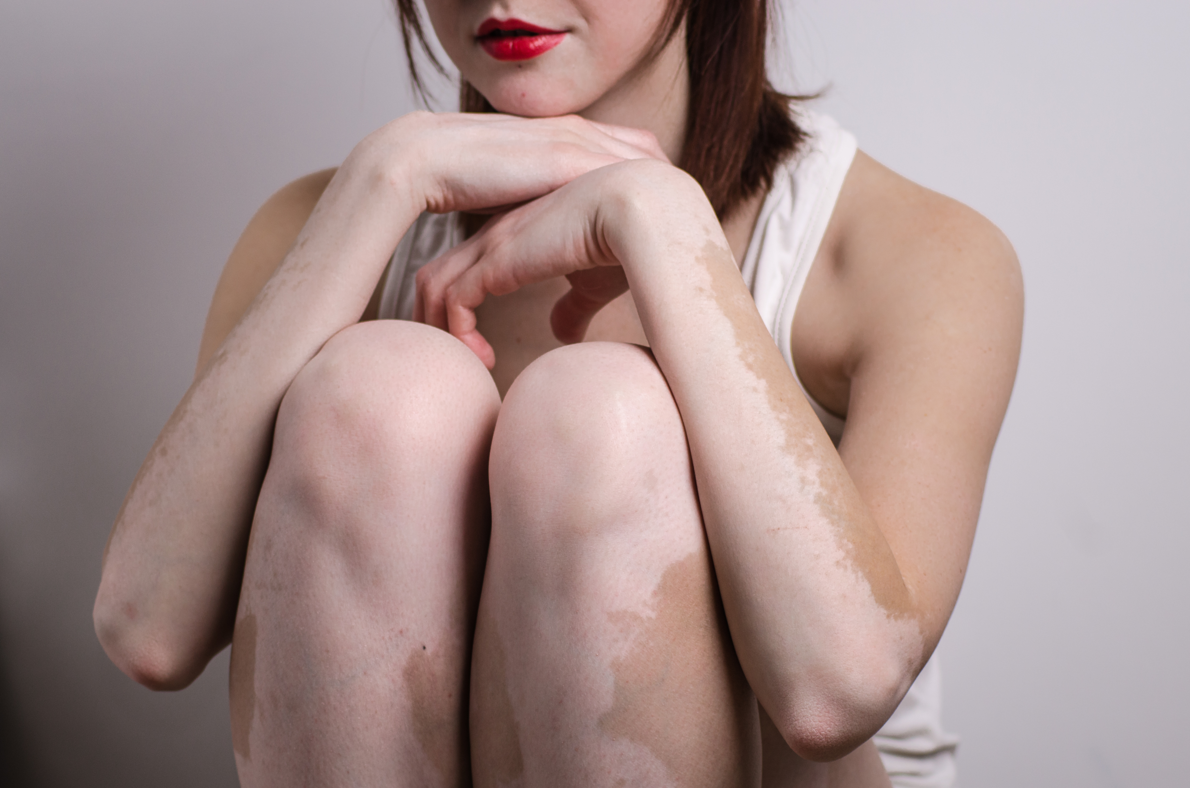 Vitiligo Nedir? Belirtileri ve Tedavi Yöntemleri